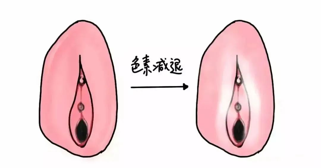 外阴白斑和白癜风有什么区别? 外阴白斑和白癜风有什么区别?