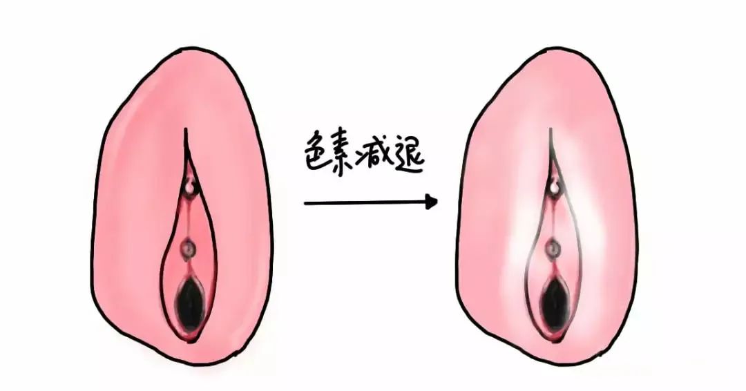 外阴白斑疾病怎么自测 外阴白斑疾病怎么自测