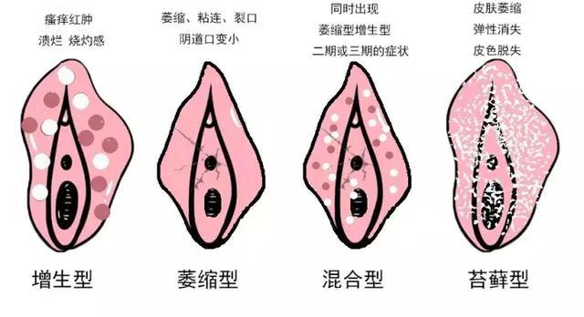 外阴白斑所引起的哪些危害影响比较大? 外阴白斑所引起的哪些危害影响比较大?