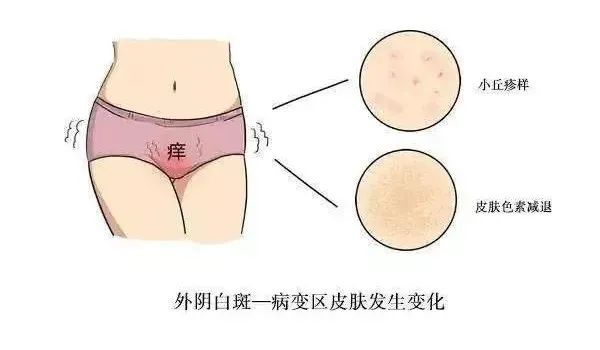 老年人外阴白斑怎么引起的? 老年人外阴白斑怎么引起的?