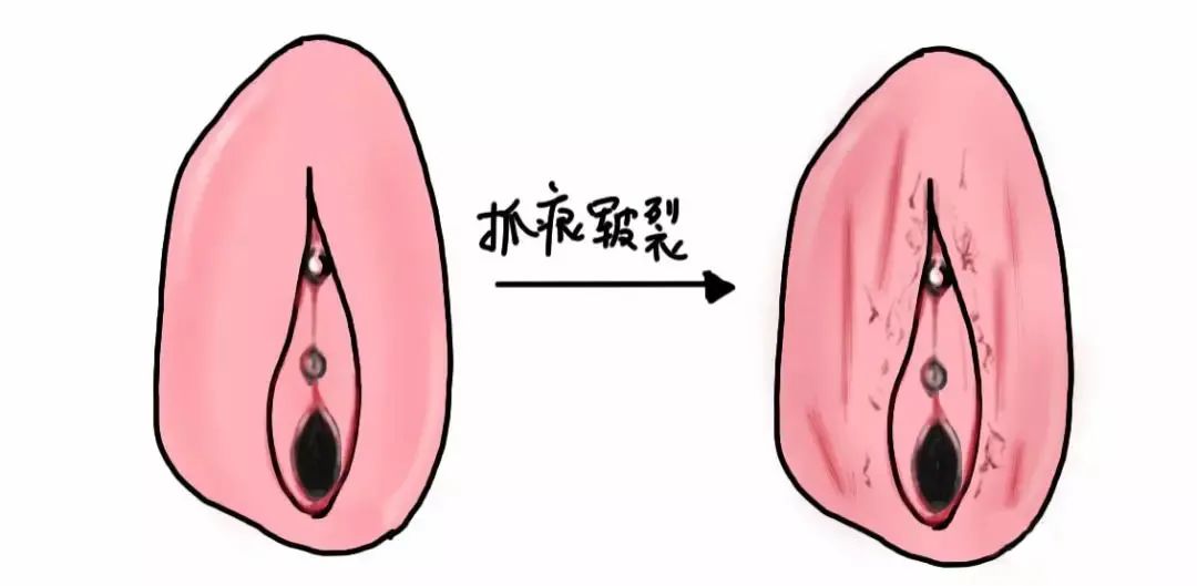 外阴白斑疾病怎么自测 外阴白斑疾病怎么自测