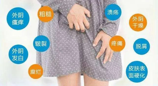 外阴白斑会传染吗? 外阴白斑会传染吗?