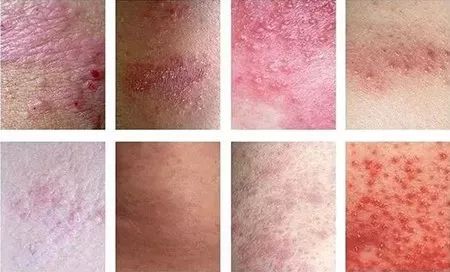 外阴白斑和外阴湿疹有什么不一样的? 外阴白斑和外阴湿疹有什么不一样的?