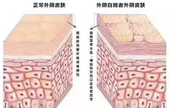 在确诊外阴白斑症状较轻会自己好起来吗? 在确诊外阴白斑症状较轻会自己好起来吗?